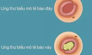Triệu chứng của ba loại ung thư da Triệu chứng của ba loại ung thư da